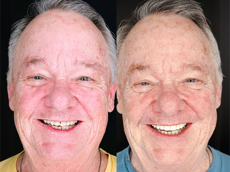 Side-by-side before and after smile transformation of a male patient at Claustro Family Dentistry