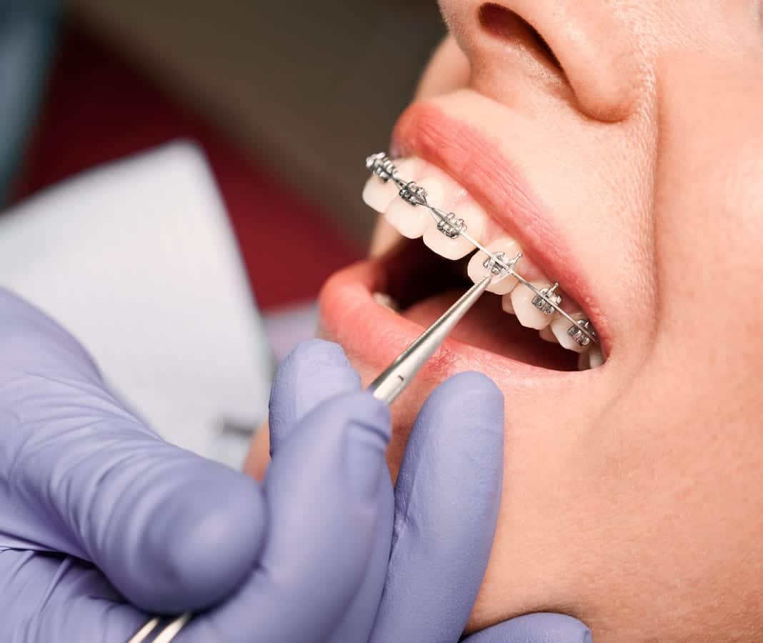 Dental Bridges in Ashburn